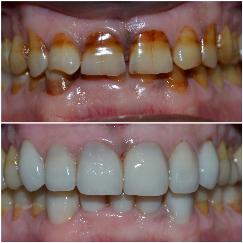 Full Mouth Rehabilitation By Simply Smiles Dental Clinic, Mumbai
