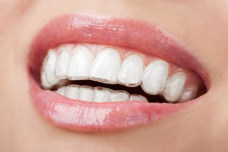 Invisible Braces - Lingual and Clear Braces - at Simply Smiles Dental Clinic, Mumbai