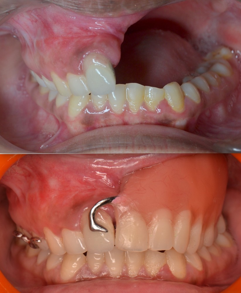 Maxillofacial Reconstruction at Simply Smiles Dental Clinic, Mumbai