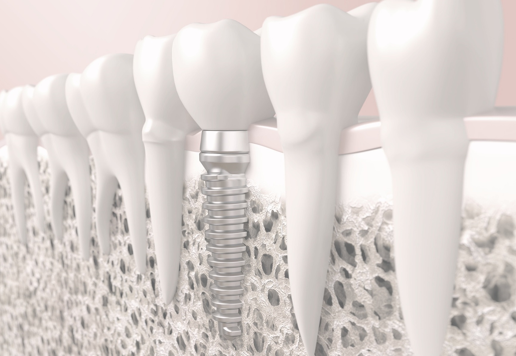 Precise and Painfree Dental Implants at Simply Smiles Dental Clinic, Mumbai